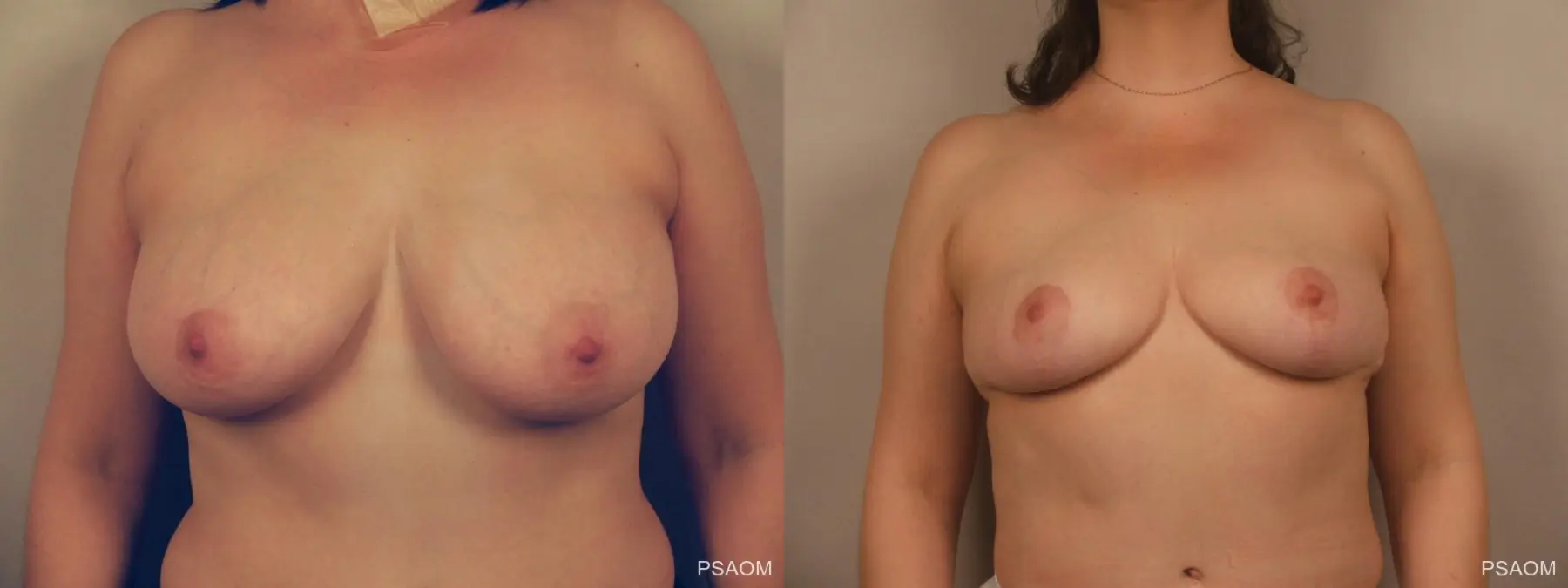 Breast Reduction: Patient 5 - Before and After  