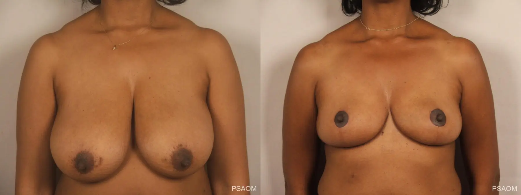 Breast Reduction: Patient 13 - Before and After  