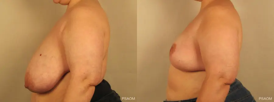 Breast Reduction: Patient 7 - Before and After 2