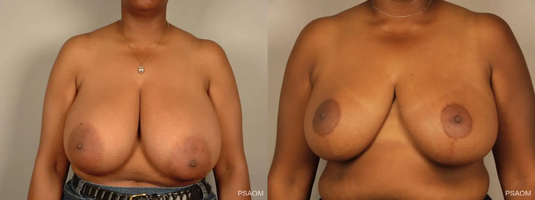 Breast Reduction: Patient 9 - Before and After 1