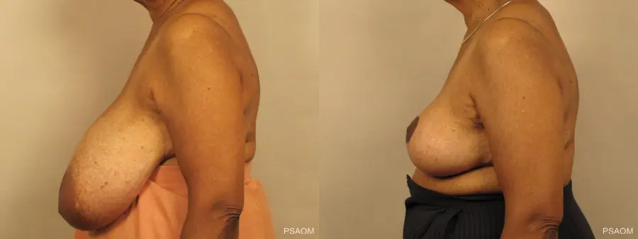 Breast Reduction: Patient 1 - Before and After 2