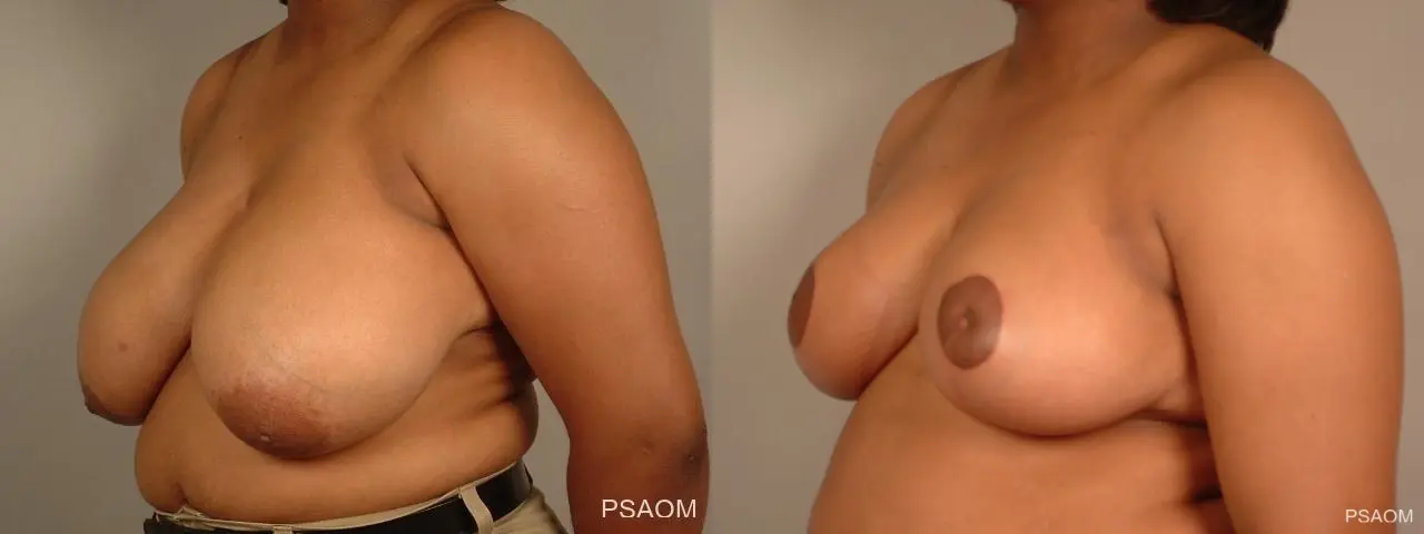 Breast Reduction: Patient 10 - Before and After 3