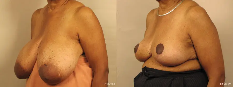Breast Reduction: Patient 1 - Before and After 3