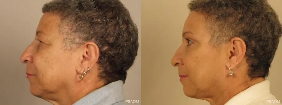 Eyelid Lift: Patient 1 - Before and After 2