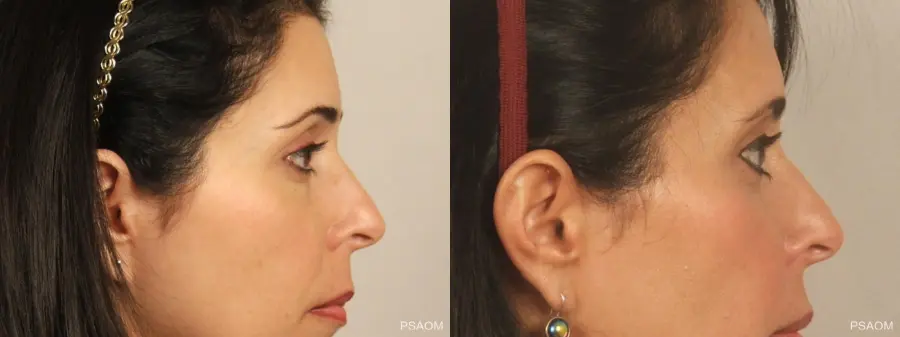Eyelid Lift: Patient 2 - Before and After 2