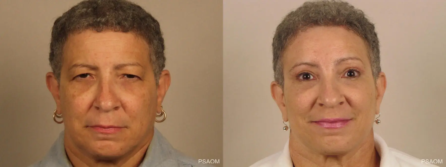 Eyelid Lift: Patient 1 - Before and After  