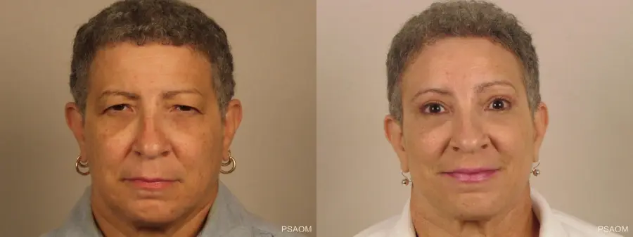 Eyelid Lift: Patient 1 - Before and After