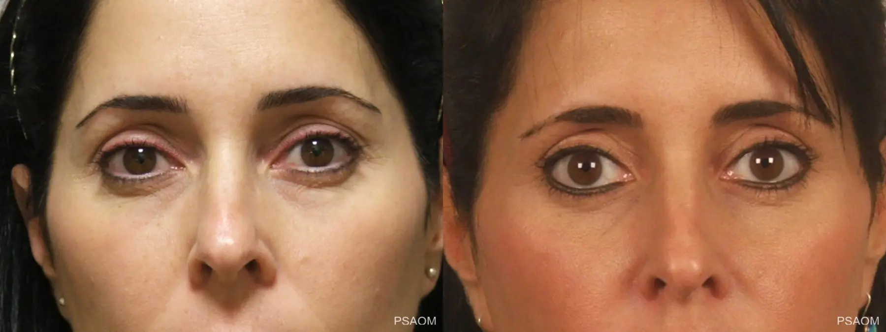 Eyelid Lift: Patient 2 - Before and After 1