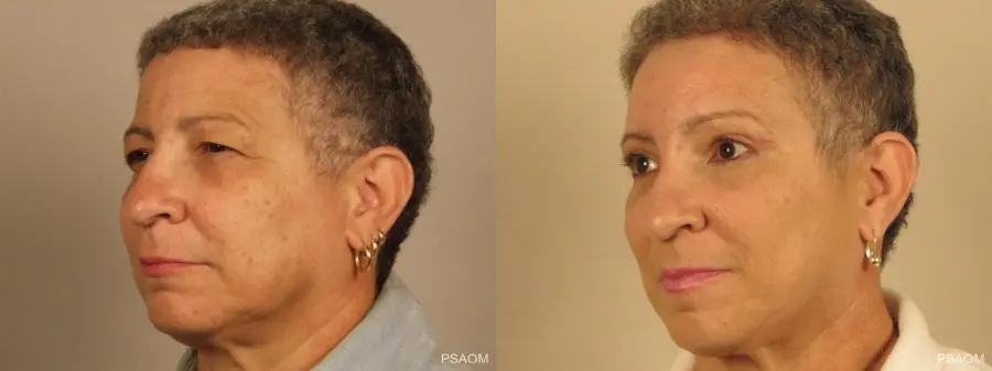 Eyelid Lift: Patient 1 - Before and After 3
