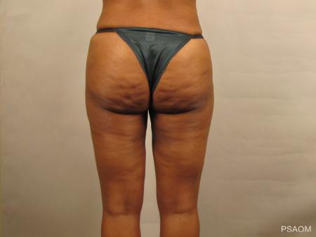 Liposuction: Patient 1 - After Image 3