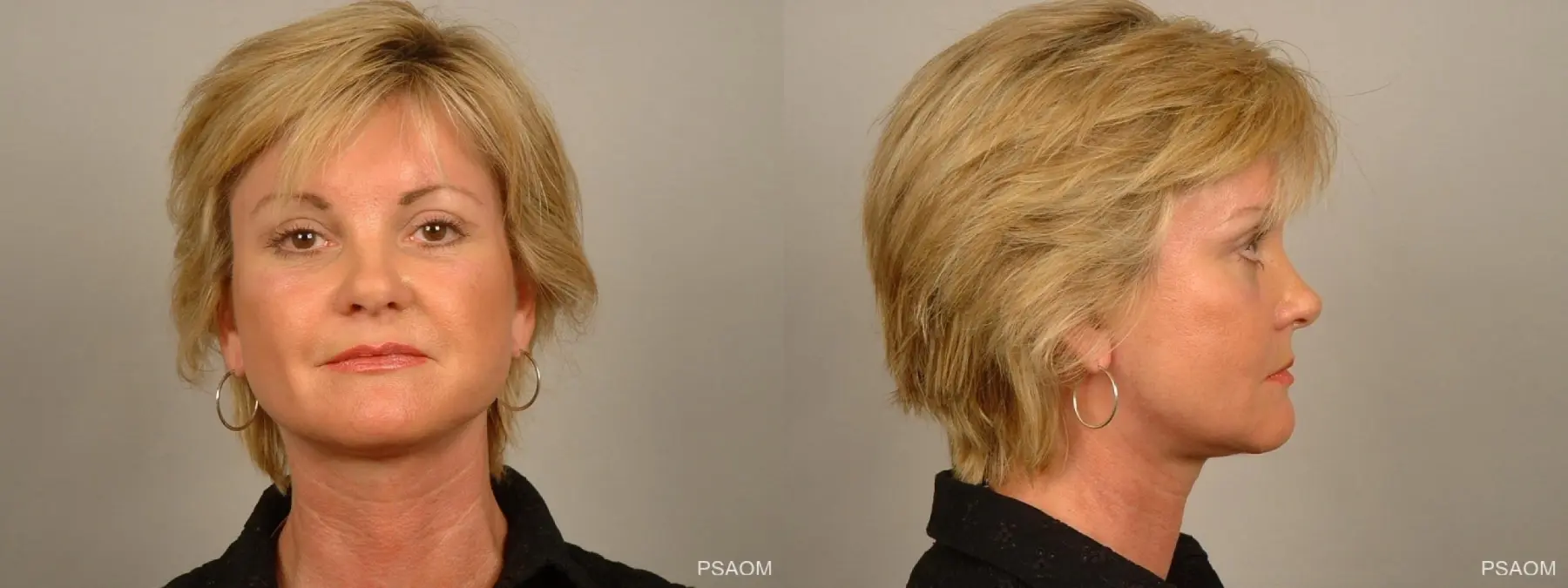 Facelift: Patient 3 - Before and After 2