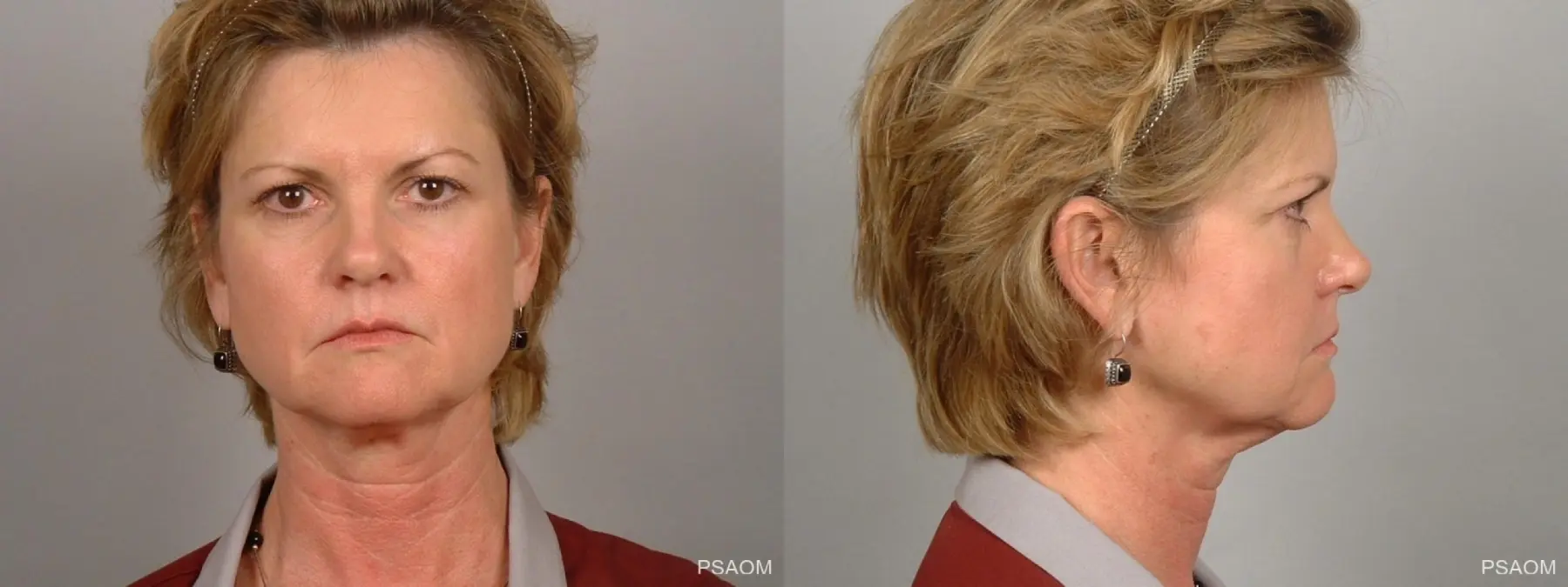 Facelift: Patient 3 - Before and After  