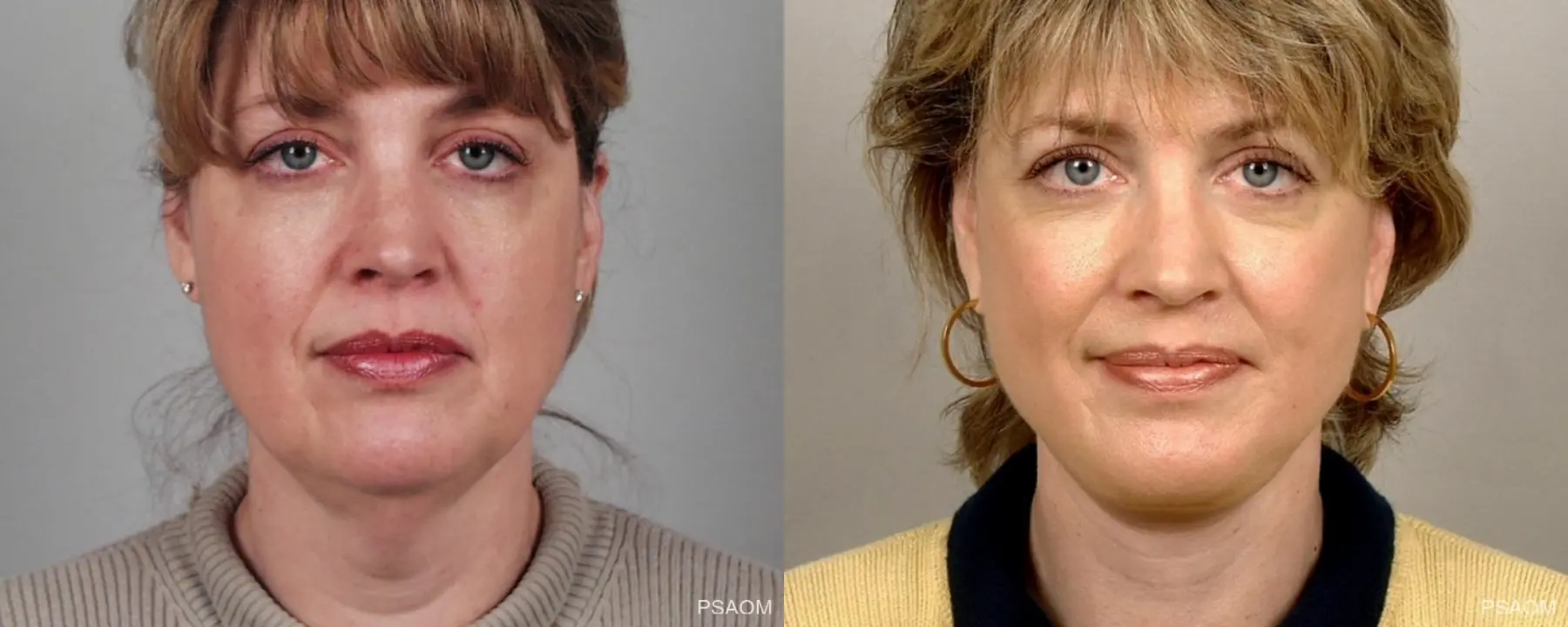 Facelift: Patient 1 - Before and After 1