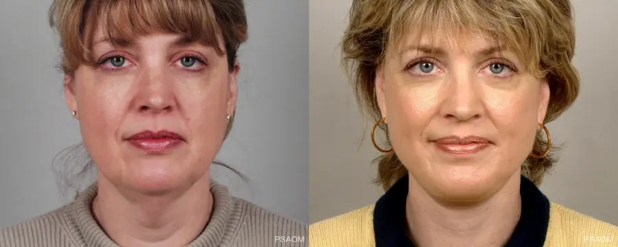 Facelift: Patient 1 - Before and After