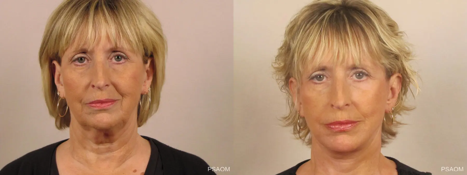 Facelift: Patient 2 - Before and After  