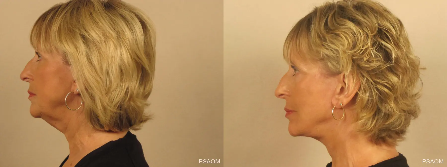 Facelift: Patient 2 - Before and After 2