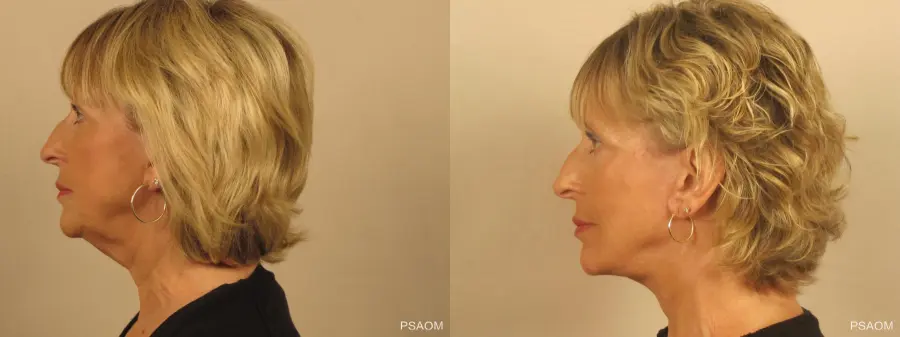 Facelift: Patient 2 - Before and After 2