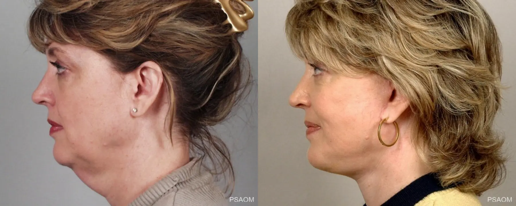 Facelift: Patient 1 - Before and After 2