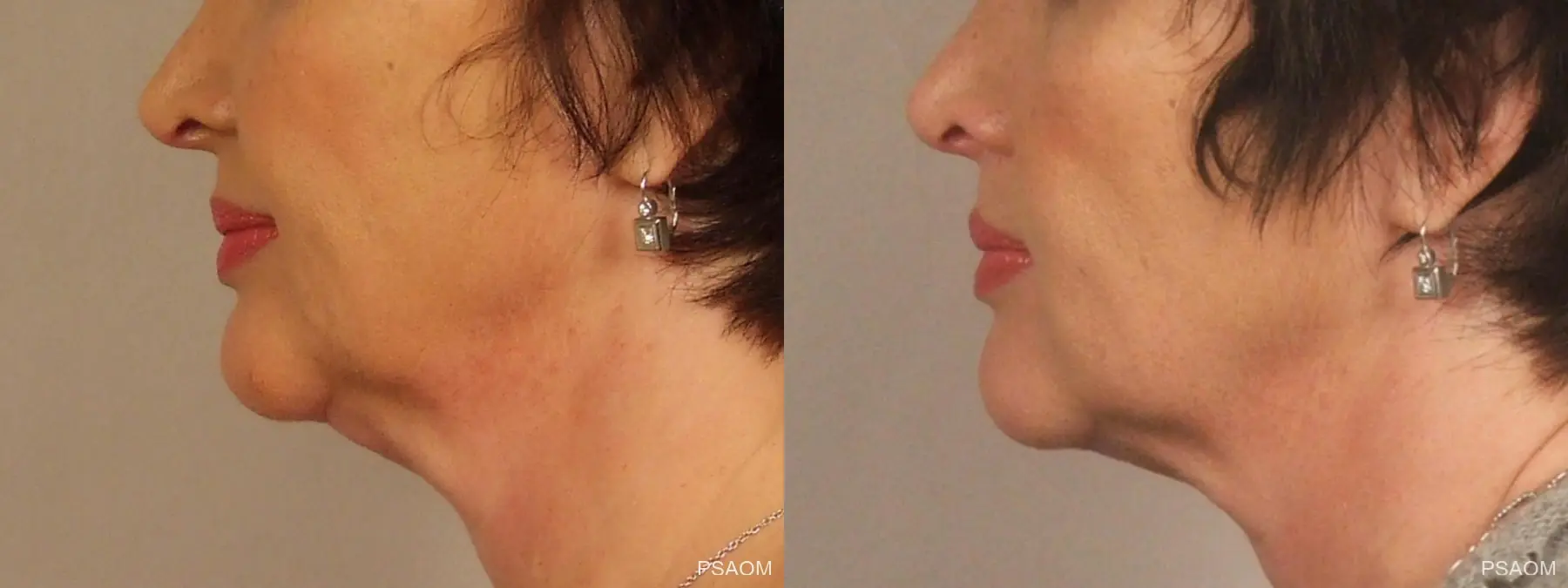 Injectables - Face: Patient 1 - Before and After 2