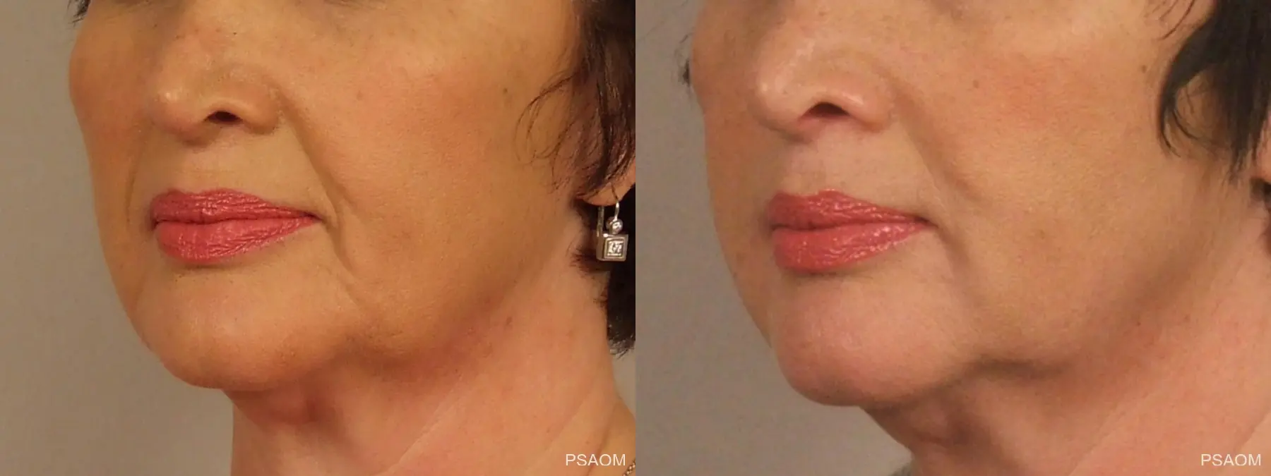 Injectables - Face: Patient 1 - Before and After 3