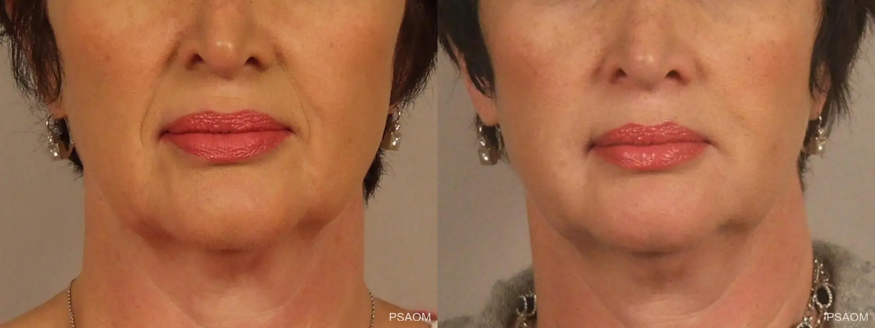 Injectables - Face: Patient 1 - Before and After  