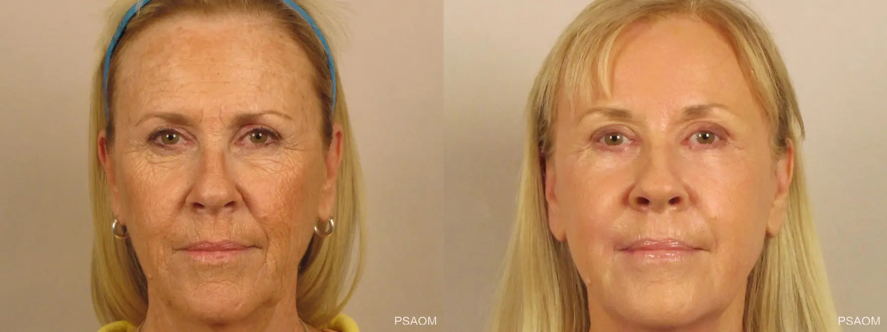 Laser Skin Resurfacing - Face: Patient 1 - Before and After  