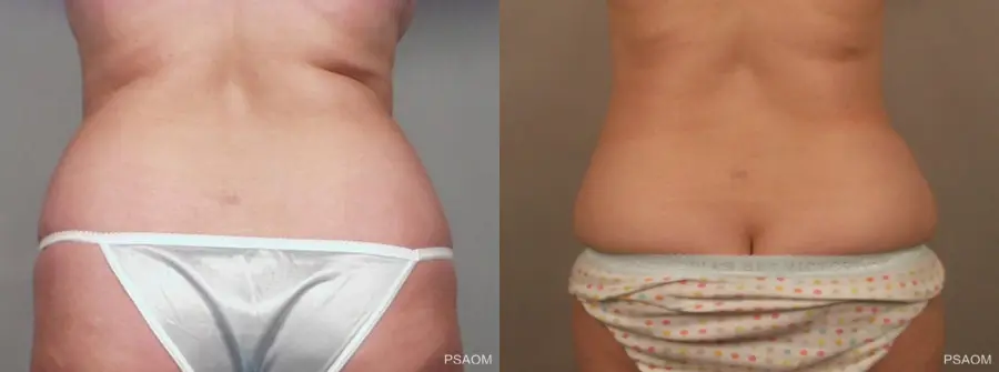 Liposuction: Patient 2 - Before and After  