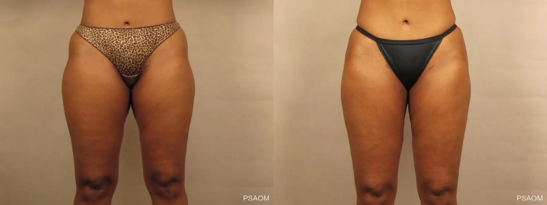 Liposuction: Patient 1 - Before and After  