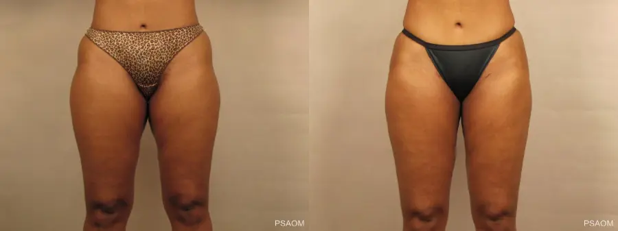 Liposuction: Patient 1 - Before and After
