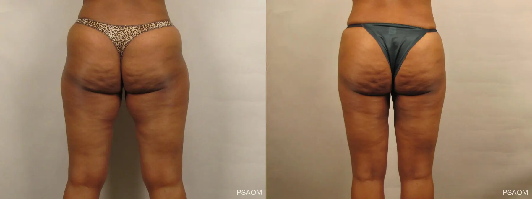 Liposuction: Patient 1 - Before and After 3