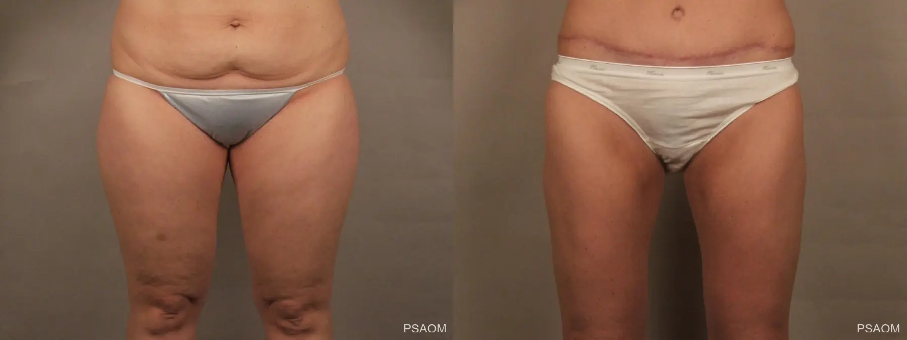 Liposuction: Patient 3 - Before and After  