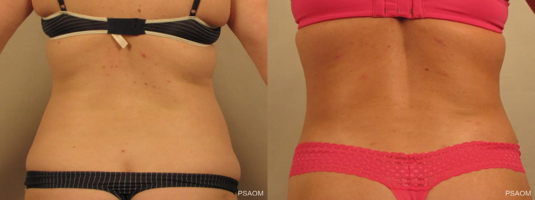 Liposuction: Patient 4 - Before and After  