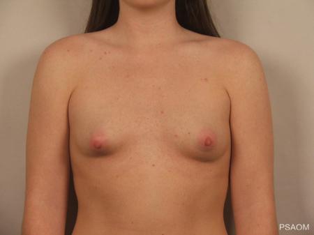 Breast Augmentation: Patient 7 - Before Image