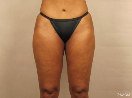 Liposuction: Patient 1 - After Image