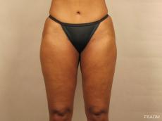 Liposuction: Patient 1 - After Image