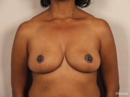 Breast Reduction: Patient 13 - After Image