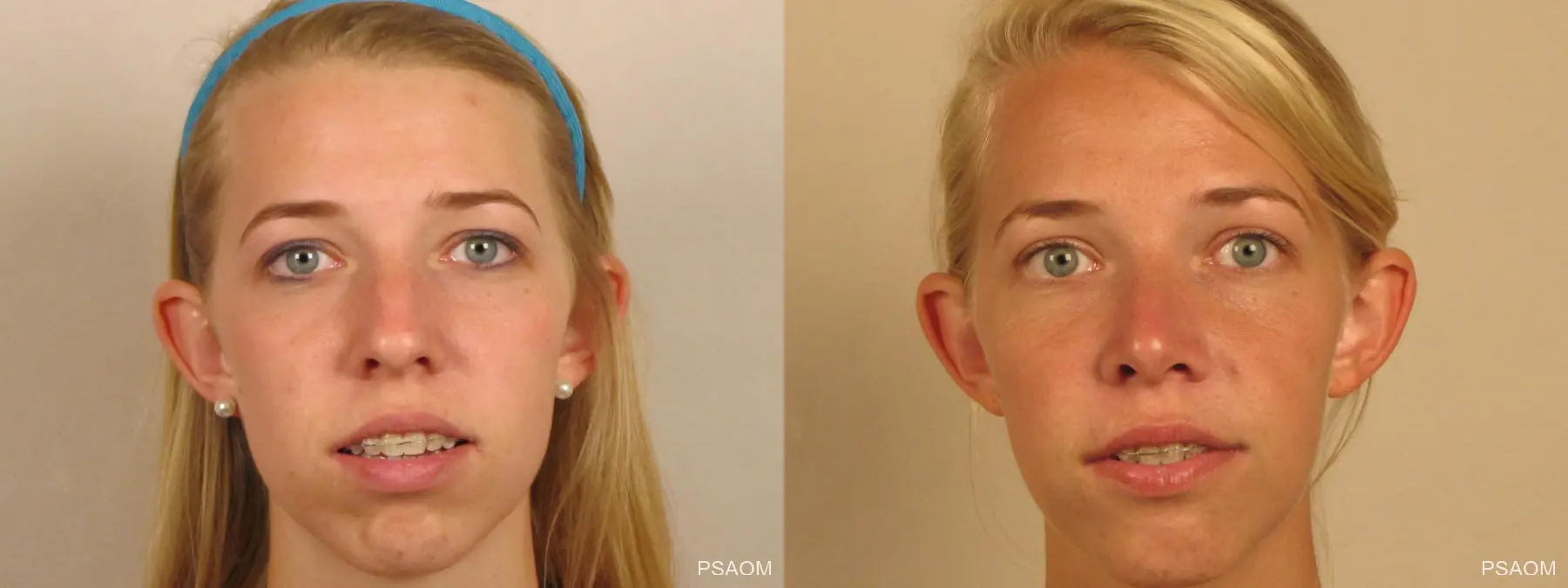 Rhinoplasty: Patient 1 - Before and After  