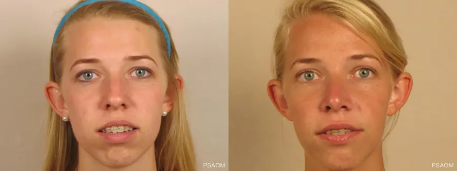 Rhinoplasty: Patient 1 - Before and After 1