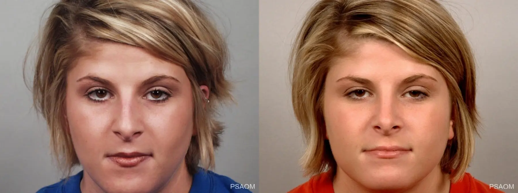 Rhinoplasty: Patient 2 - Before and After  