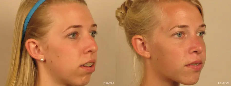 Rhinoplasty: Patient 1 - Before and After 3