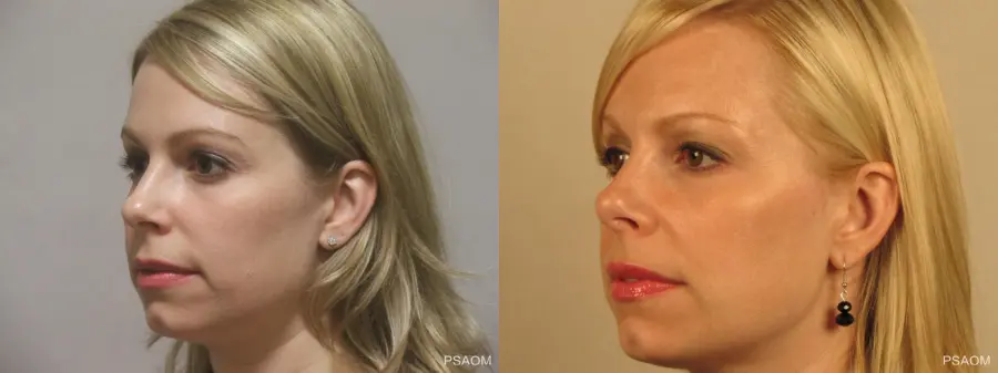 Rhinoplasty: Patient 3 - Before and After 3
