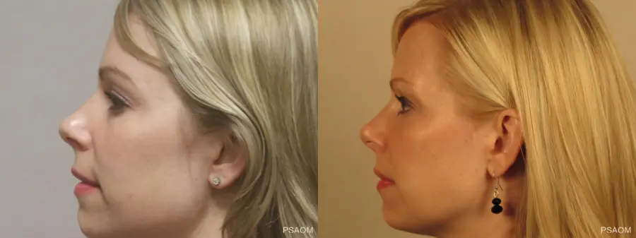 Rhinoplasty: Patient 3 - Before and After 2