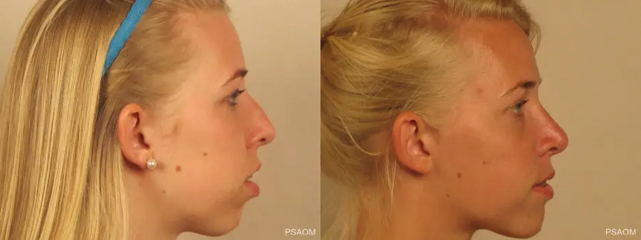 Rhinoplasty: Patient 1 - Before and After 2