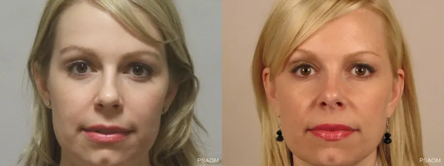 Rhinoplasty: Patient 3 - Before and After 1