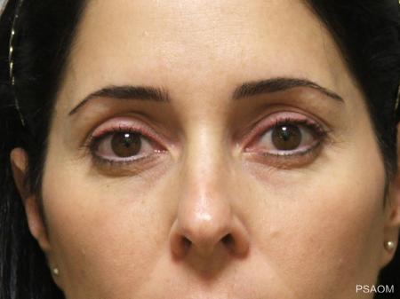 Eyelid Lift: Patient 2 - Before Image