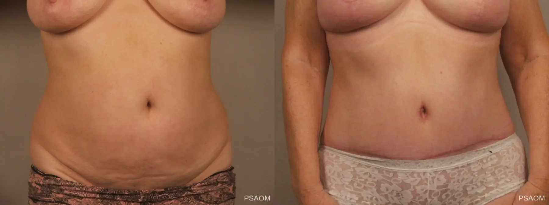 Tummy Tuck: Patient 2 - Before and After  