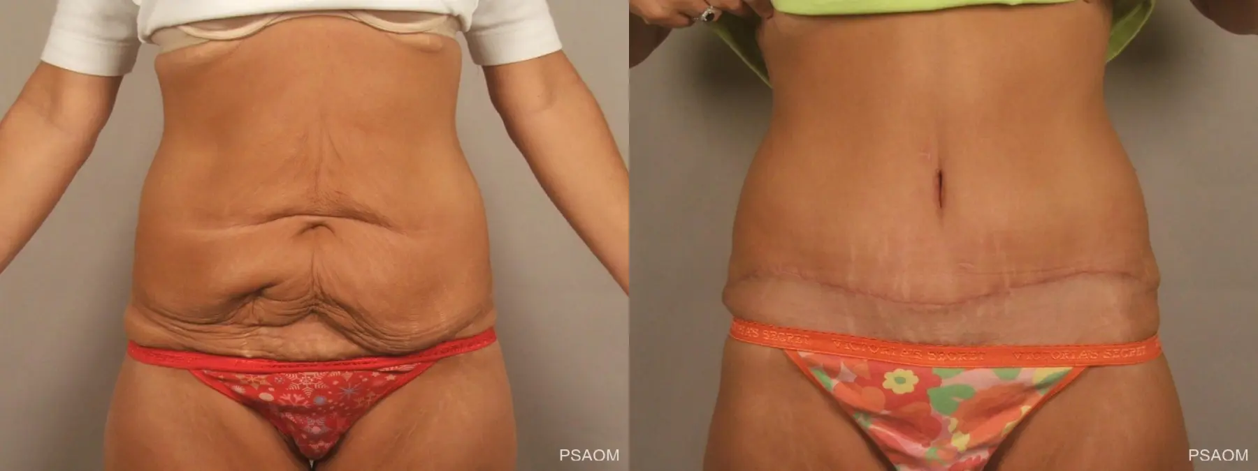 Tummy Tuck: Patient 4 - Before and After  