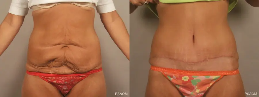 Tummy Tuck: Patient 4 - Before and After