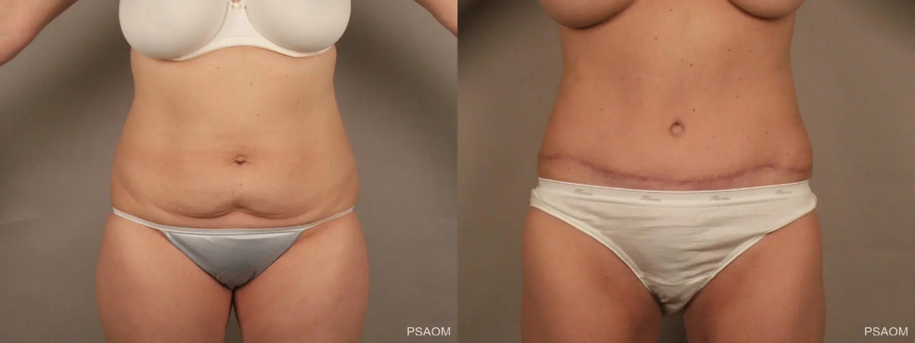 Tummy Tuck: Patient 1 - Before and After  