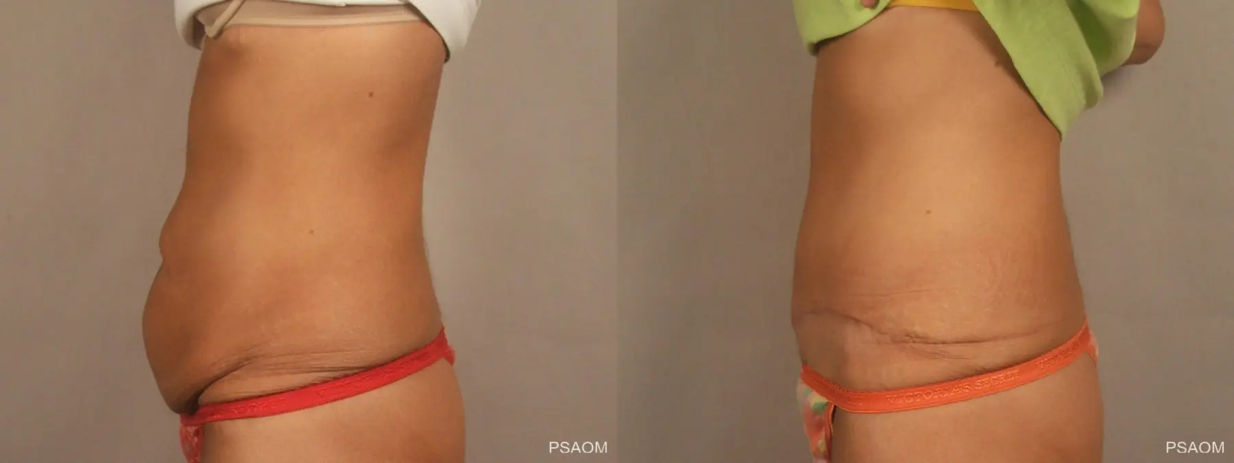 Tummy Tuck: Patient 4 - Before and After 2